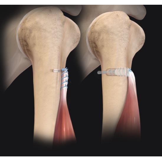 Kotwice do szwów do artroskopii ARTHREX FiberTak Button