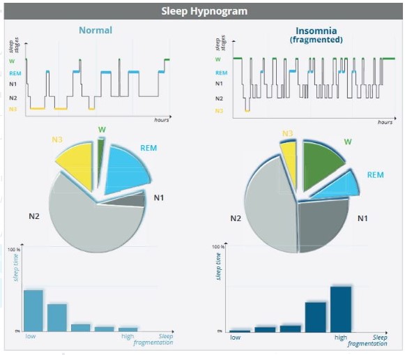 Aparaty do diagnostyki bezdechu sennego - polisomnografy SOMNOmedics HST REM+